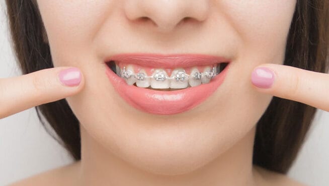 Descubre el Nombre del Alambre Utilizado en los Brackets: Todo lo que Debes Saber
